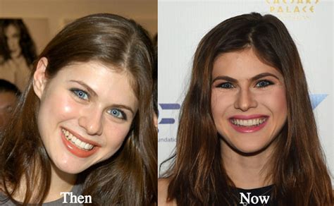 did alexandra daddario get a boob job|Alexandra Daddario Breast Augmentation Journey